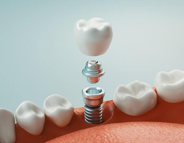 Implantes Dentários - Goldmann